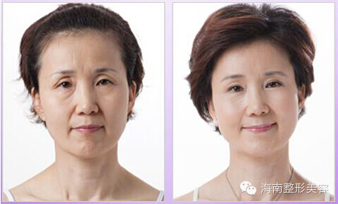 海南整形面部年輕化.jpg