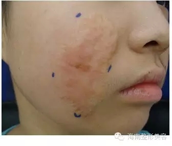 面部疤痕.webp.jpg