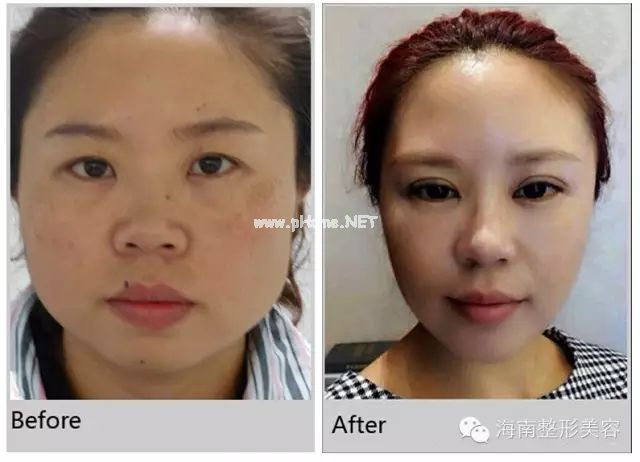 林博士手術(shù)案例