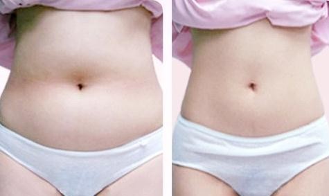 腰部吸脂——卞小姐