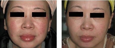 激光去紅血絲——王女士