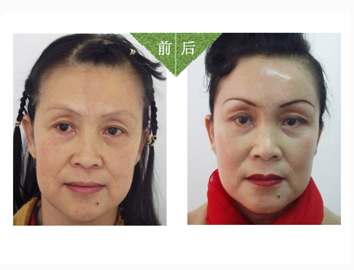 注射愛(ài)貝芙除皺——謝女士