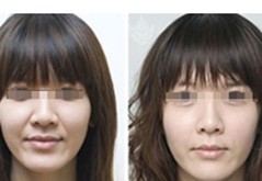 伊維蘭注射除皺案例——王女士