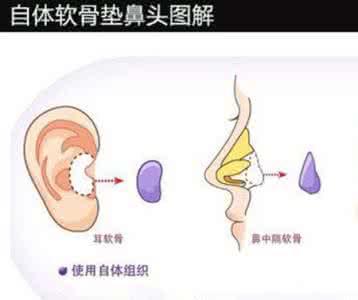 自體耳軟骨.jpg
