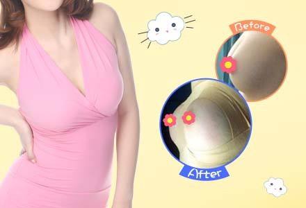 假體隆胸-林賢超醫(yī)生