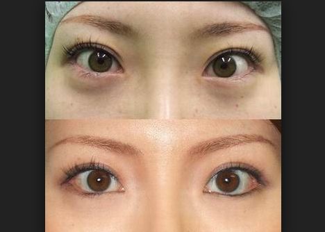 開眼角-海南整形