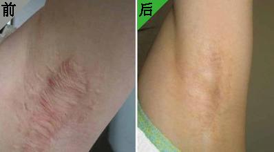 疤痕軟化.jpg
