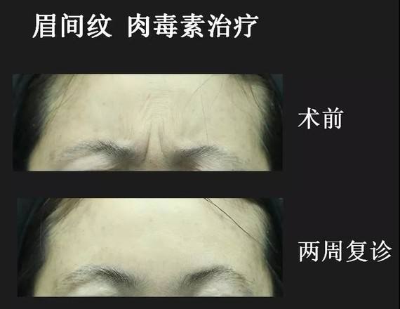 除皺肉毒素.jpg
