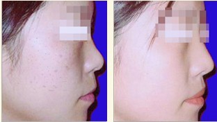 光子嫩膚——張小姐