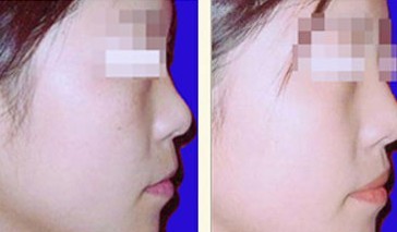 激光去雀斑——寧女士