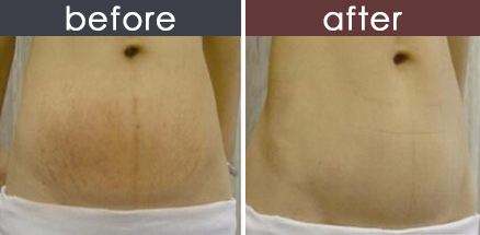 祛妊娠紋.jpg