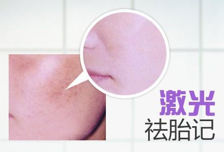 激光去除胎記.jpg