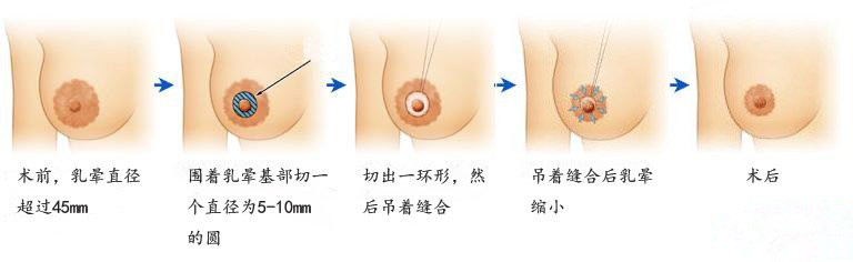 乳暈縮小手術(shù).jpg