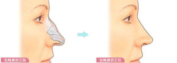 駝峰鼻手術.jpg