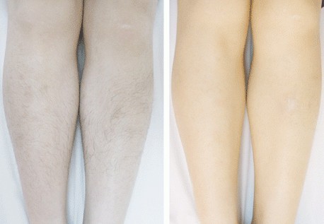 小腿冰點(diǎn)脫毛——莊小姐