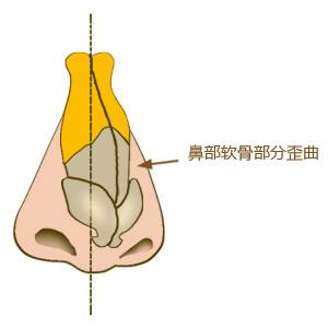 歪鼻矯正術(shù).jpg