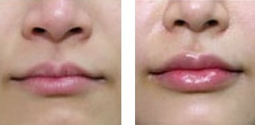 水晶塑唇——姜女士