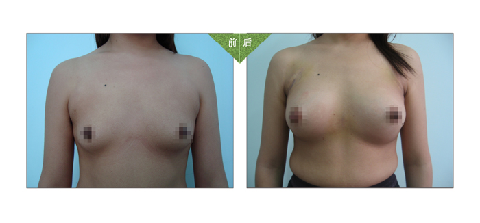 妙桃隆胸——余小姐