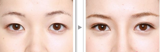 韓式重瞼術(shù)——楊小姐