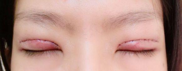 雙眼皮修復(fù).jpg