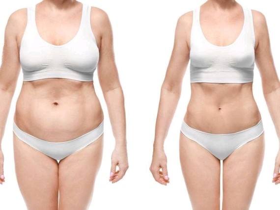 腰部吸脂效果-林賢超